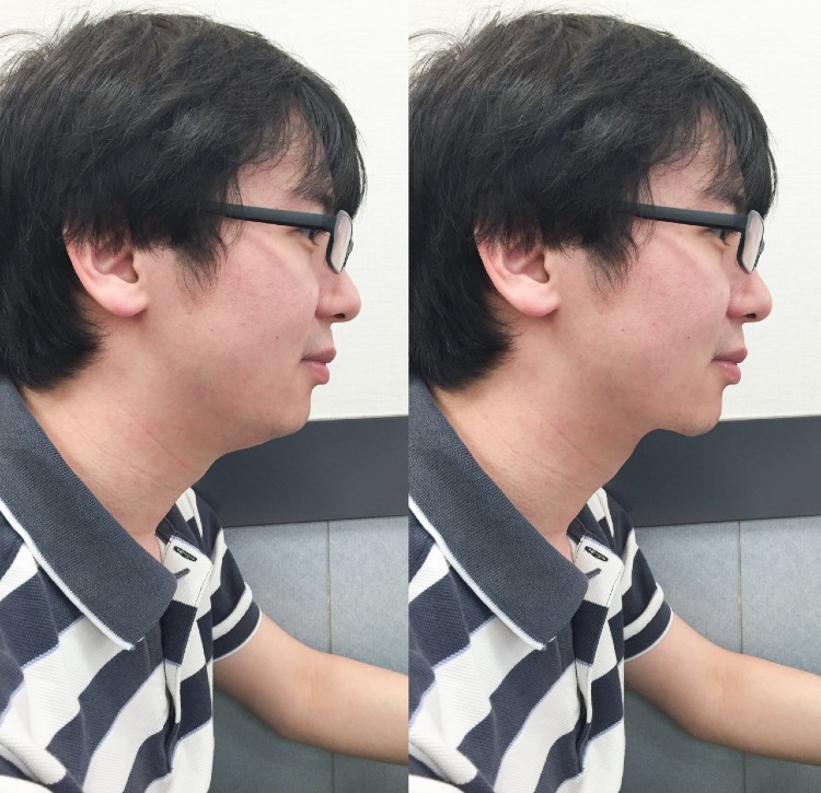 顎ラインすっきり