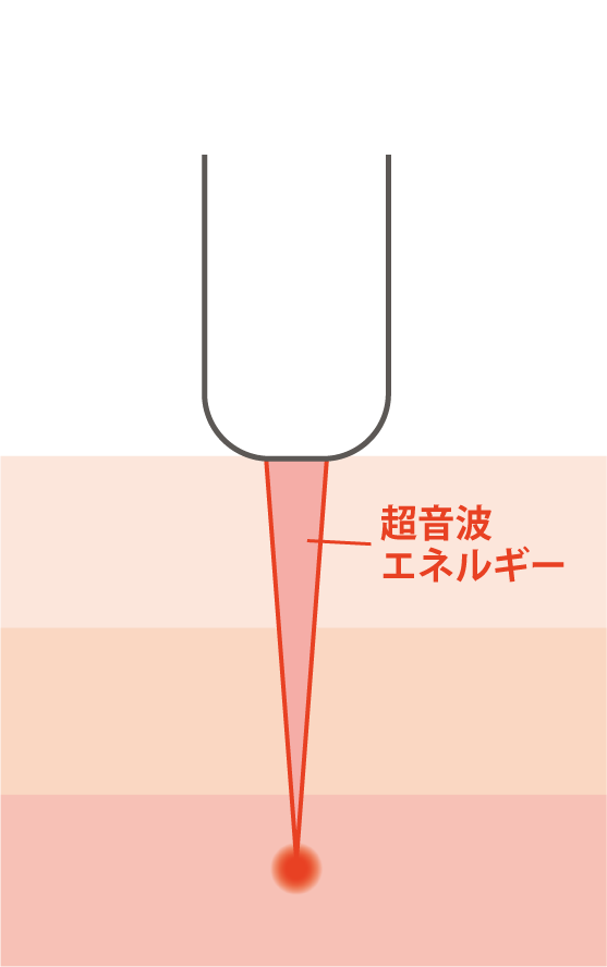ハイフォーカス技術