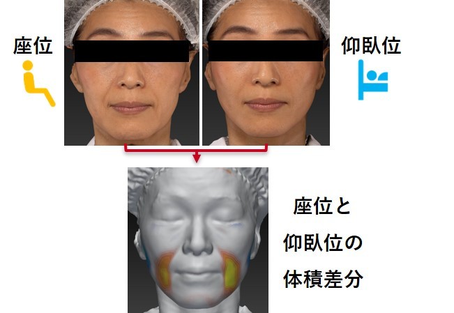たるみ指数