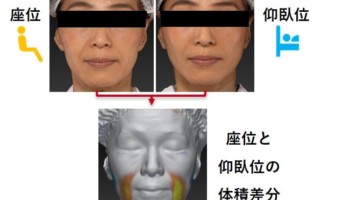 たるみ指数